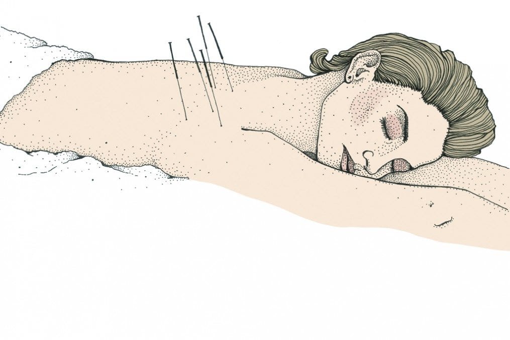 Acupuncture