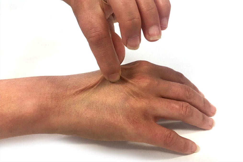 dehydration test on the skin